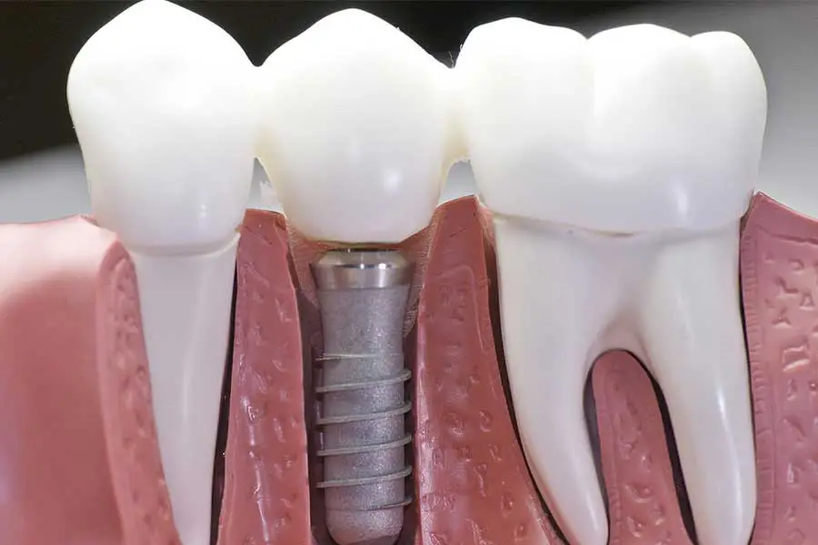 display showing teeth and implant